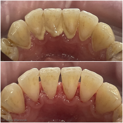Przykład zębów przed i po skalingu