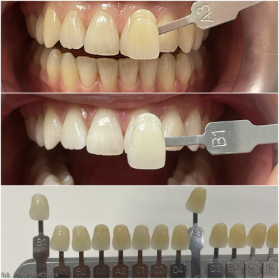 efekt wybielania zębów